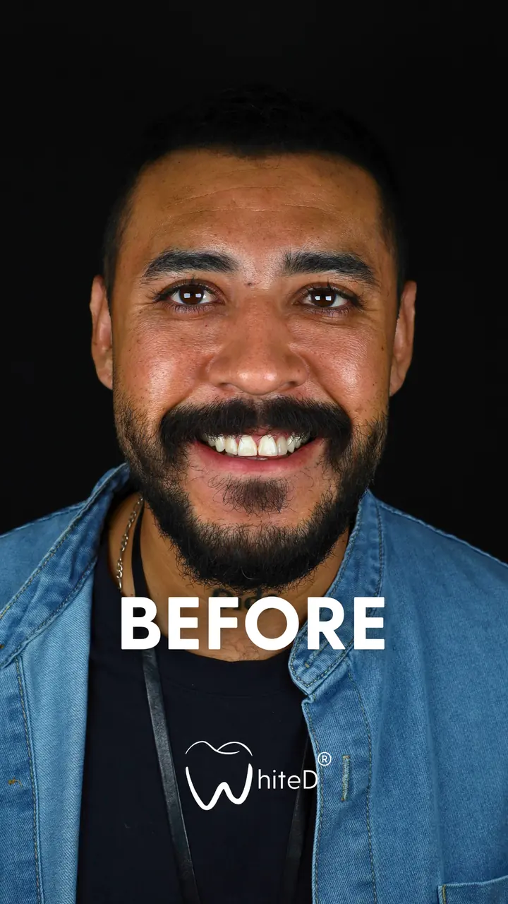 Antes del diseño de sonrisa con carillas en WhiteD · caso 2