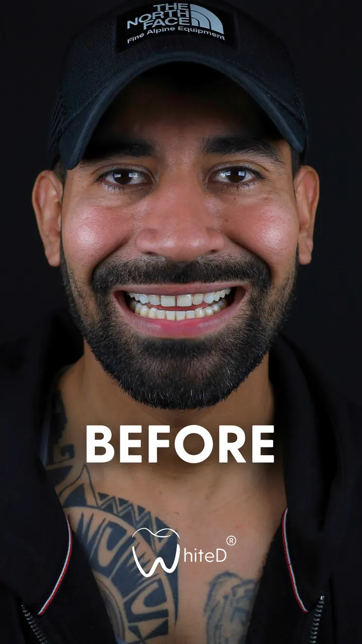 Antes del diseño de sonrisa con carillas en WhiteD · caso 4