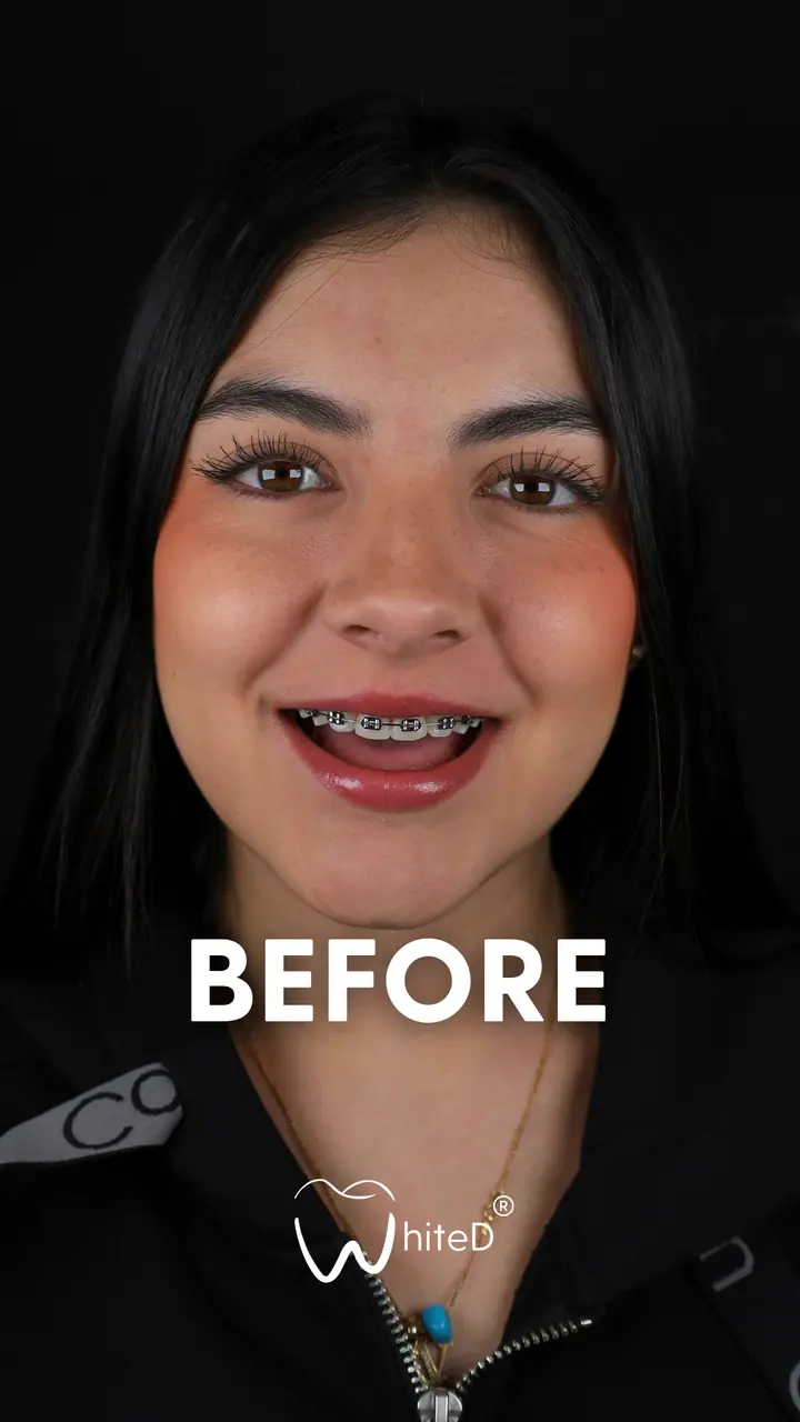 Antes del diseño de sonrisa con carillas en WhiteD · caso 5