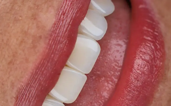 Diseño de sonrisa con carillas de resina estratificadas en CDMX